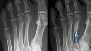 What is a Stress Fracture?