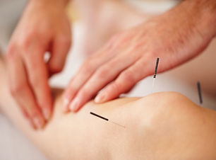 acupuntura