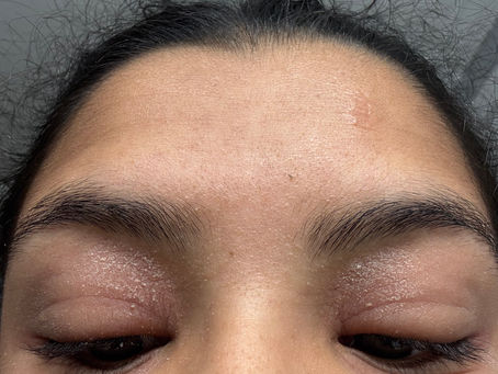 Case of a Sudden, Severe Allergic Reaction/ Hives