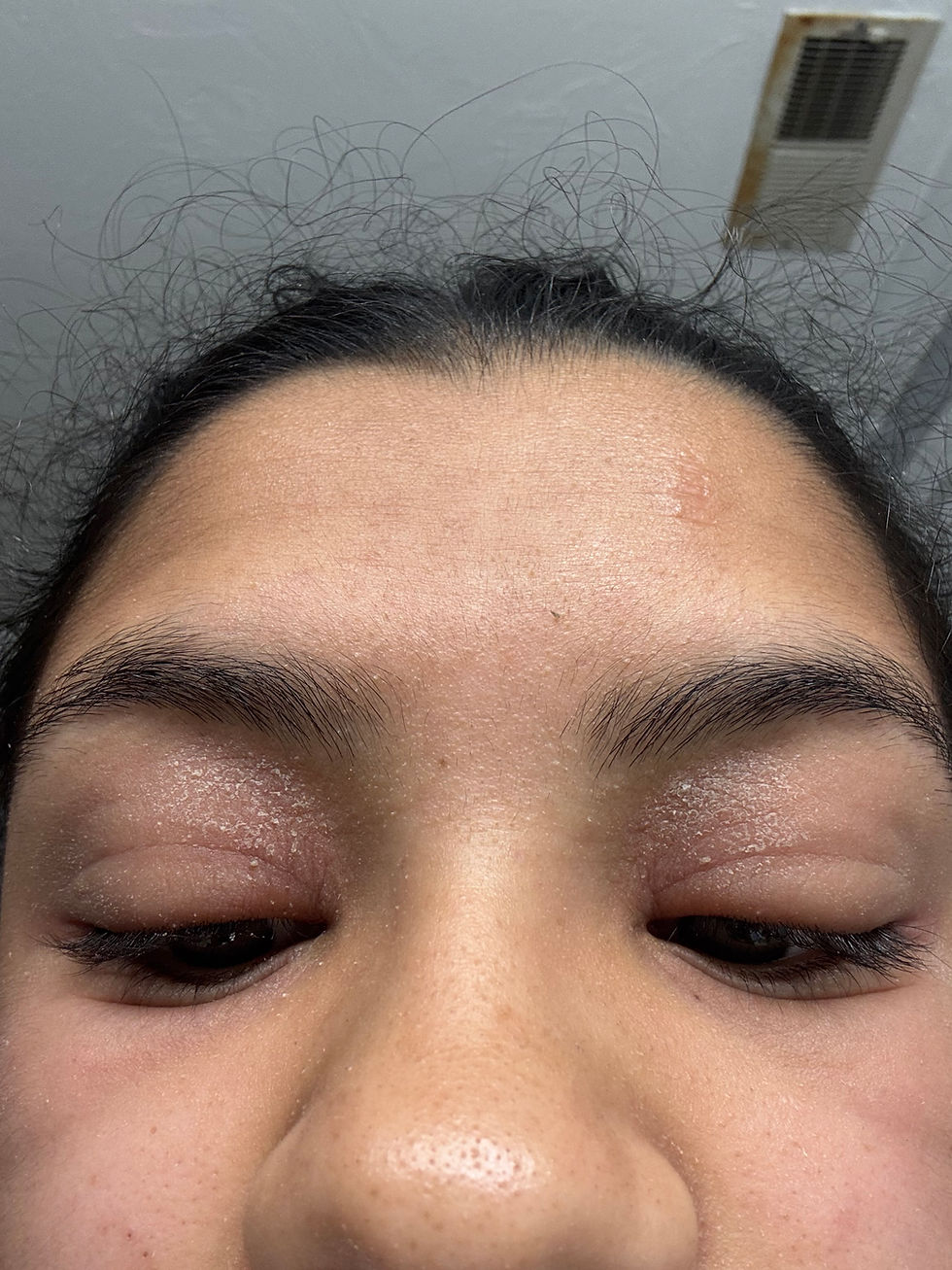 Case of a Sudden, Severe Allergic Reaction/ Hives