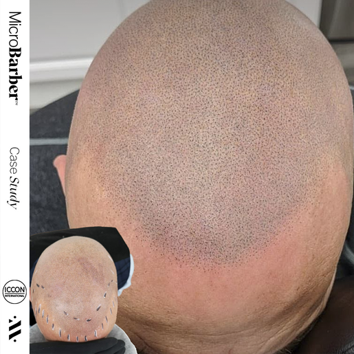 microbarber smp micropigmentation scalp regina saskatoon top