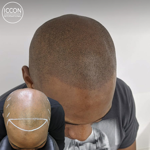 microbarber smp micropigmentation scalp regina saskatoon top