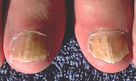 579-onychomycosis-public-health-image-library-high_es.jpg