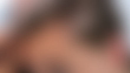 נשירת שיער טלוגנית