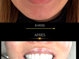 Aligneurs transparents : 3 cas avant/après pour comprendre ce qu’il est possible de corriger