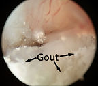 Bunion-Endoscopic2a-768x674.jpg