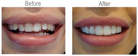 original_veneer-deluca.png