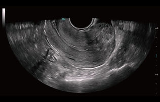 consona-n7-fig5-6 uterine fibroid.jpeg