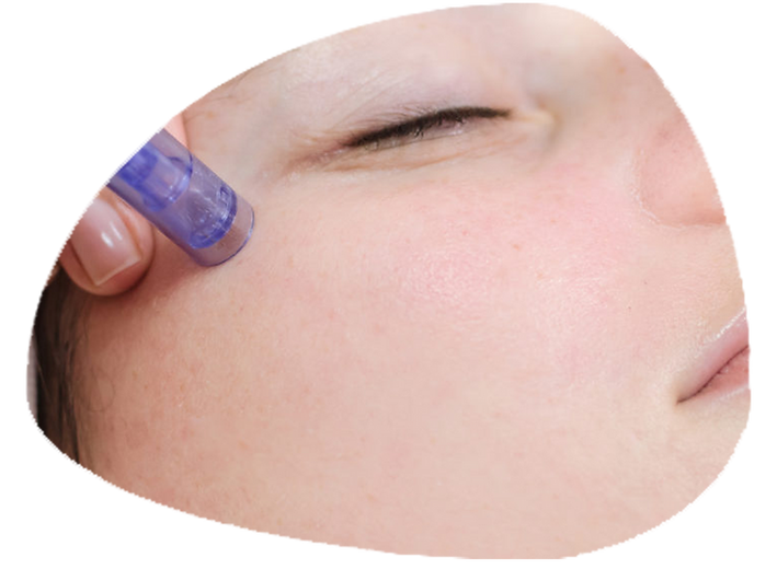 microneedling-with-dermapen.png