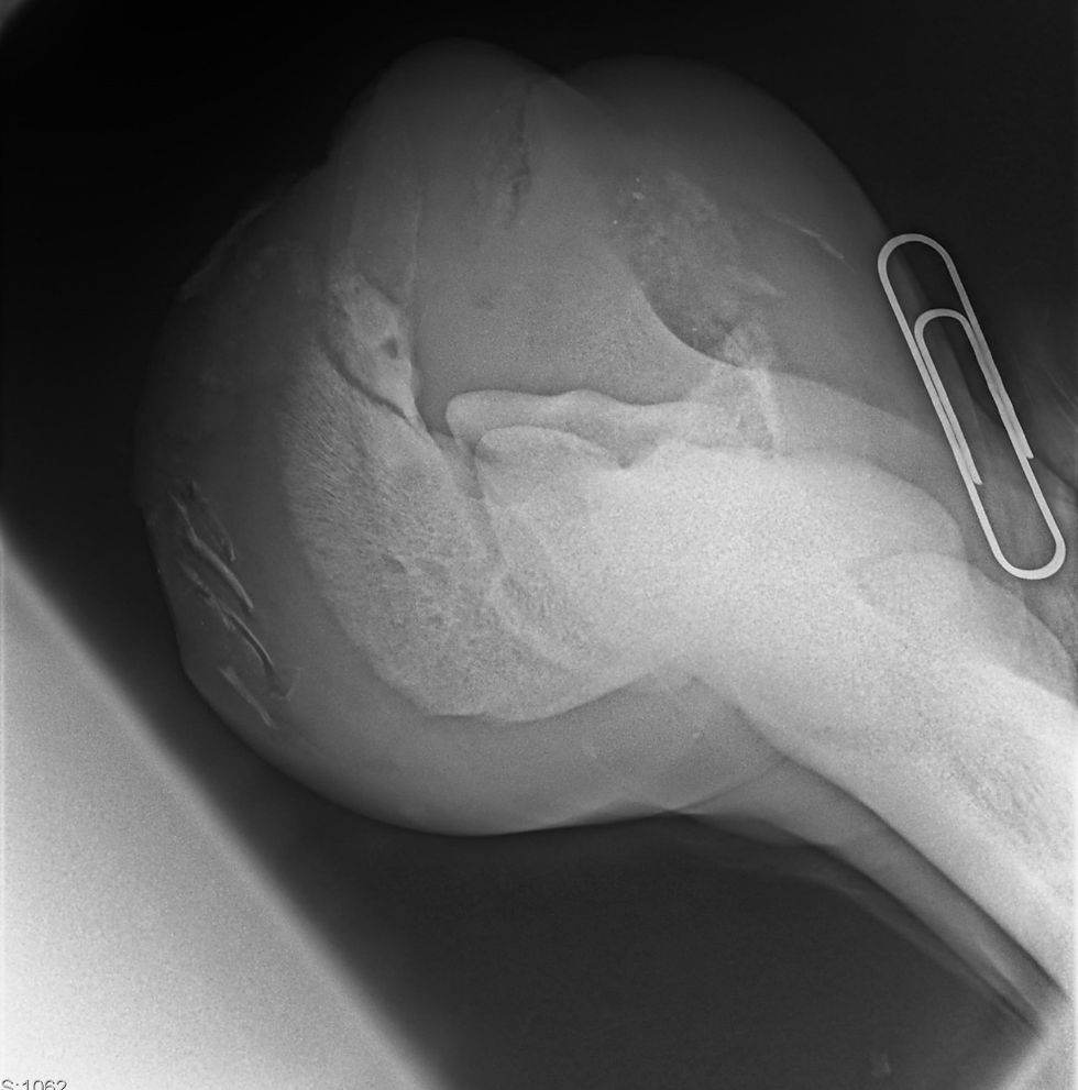 Fig. 1 A wing fracture of the pedal bone on an X-ray