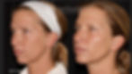 Sculptra, Chin Filler, Dysport
