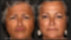 VI Peel, Dysport & Filler