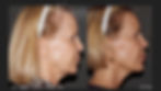 Sculptra
