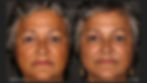 VI Peel, Dysport & Filler