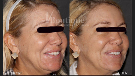 Dysport for Bell's Palsy