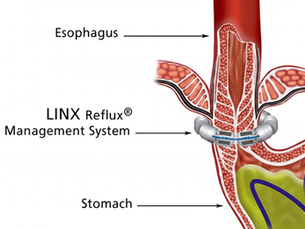 LINX diagram
