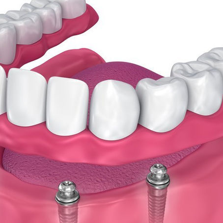 ¿QUÉ SON LAS SOBREDENTADURAS SOBRE IMPLANTES?