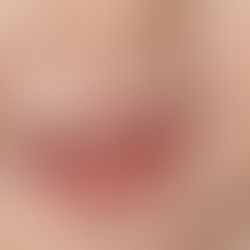 ERUPCIÓN DENTAL TARDÍA, ¿EN QUÉ CONSISTE Y CUÁNDO OCURRE?