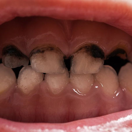 CARIES INFANTIL: QUÉ LA CAUSA Y CÓMO PREVENIRLA