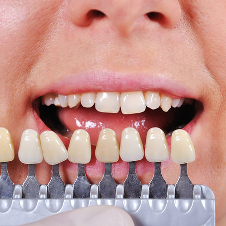DIENTES OSCUROS, ¿POR QUÉ LOS TENGO Y QUÉ TRATAMIENTOS EXISTEN?