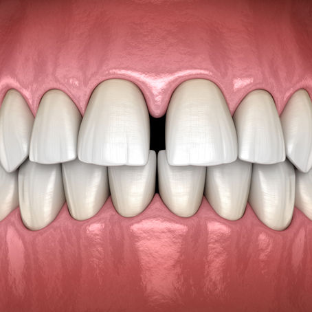 PROBLEMAS QUE AFECTAN LOS DIENTES EN ESTÉTICA DENTAL Y SUS SOLUCIONES