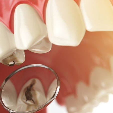 ¿CUÁLES SON LAS PRINCIPALES INFECCIONES DENTALES?