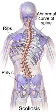 X-ray Diagram of Scoliosis taken from Wikipedia