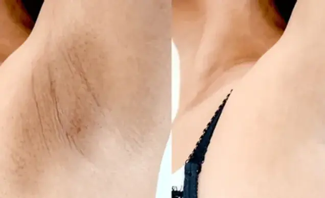 Intimate Skin Bleaching For Armpits