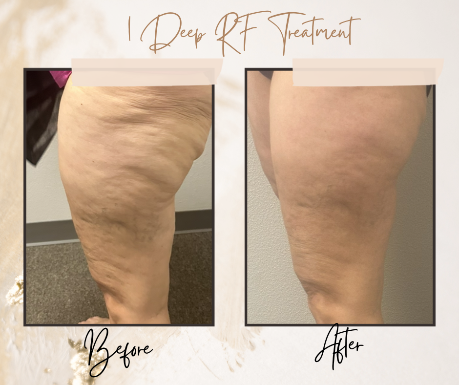 radiofrequency microneedling for loose skin on thighs