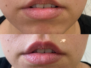 Preenchimento Labial Sorocaba #preenchimentolabialsorocaba
