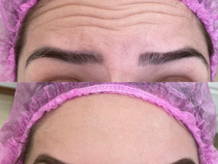 Especialista em Aplicação de Botox ® em Sorocaba. Botox ® facial em Sorocaba