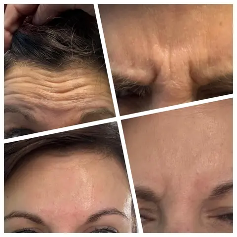 Botox