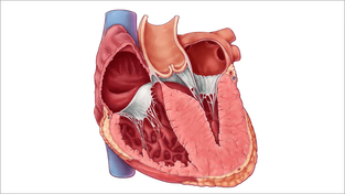 Miocardiopatia Hipertrófica Obstrutiva (MHO)