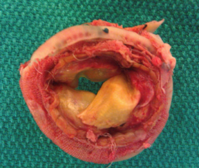 Trombose de prótese valvar