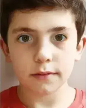 strabismus