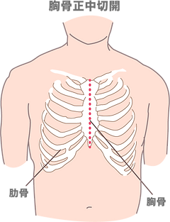 日本小児循環器学会 心臓手術の流れ 開胸