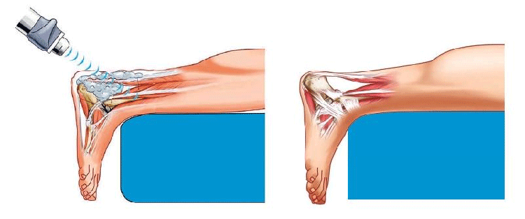 Image result for shockwave therapy