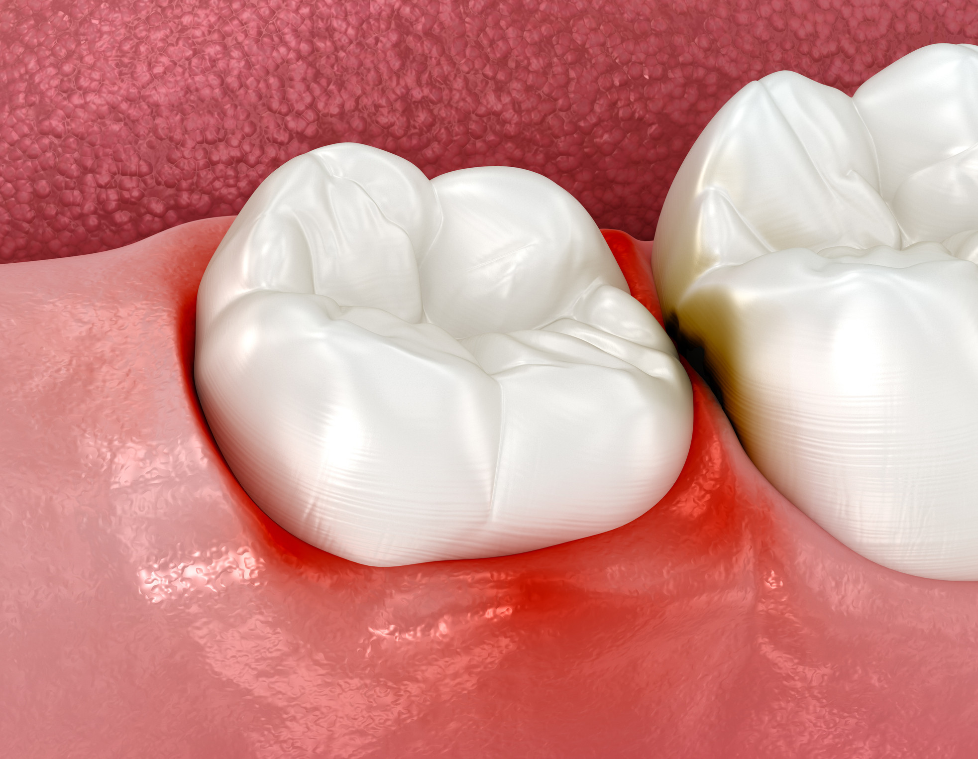Emergency Dental Infections | Electric City Dentistry