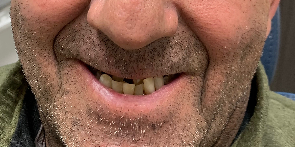 MG-SmileTransformation-with-full-mouth-implants-BEFORE.png