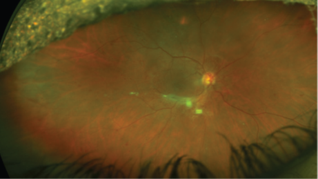 მკურნალობისშემდგომი დაკვირვების შეწყვეტის (LTFU) პრობლემასთან ბრძოლის სტრატეგია