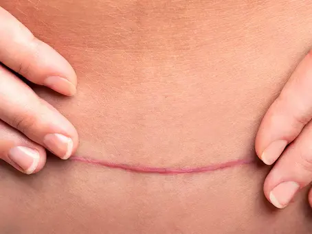 Existe cirurgia plástica sem cicatriz?