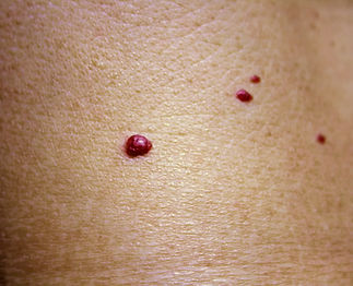 Angioma. Red birthmark on the skin surface..jpg