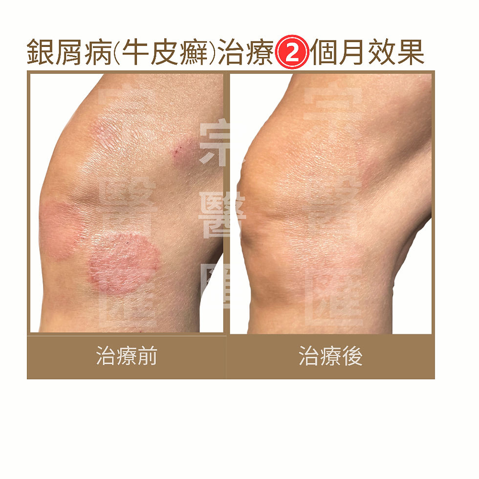 銀屑病,牛皮癬