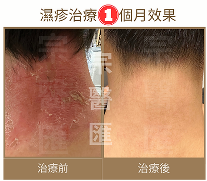 中醫濕疹治療效果