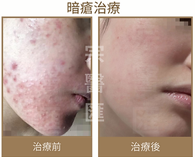 暗瘡 ACNE 中醫