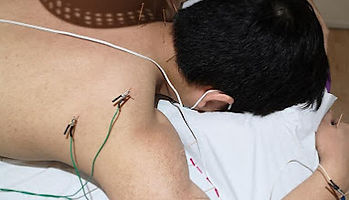 Electroacupuncture treatment