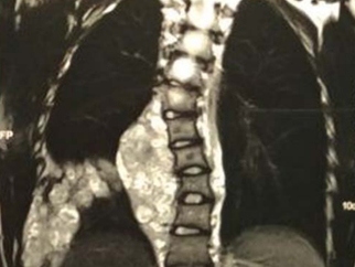 Dr. Valmor relata caso de neurofibroma em Revista científica