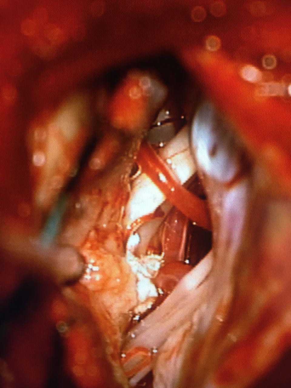 Espasmo hemifacial