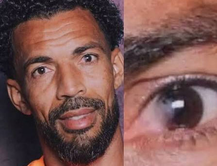Pterygium growth on the eye of a Vozinha, the goalkeeper for Cabo Verde.