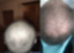 Regrowth of Hair